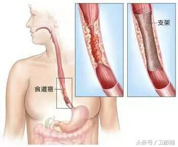 微创介入科一卫毅楠,什么是血汗管介入治疗