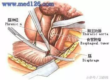 微创介入科一卫毅楠,什么是血汗管介入治疗