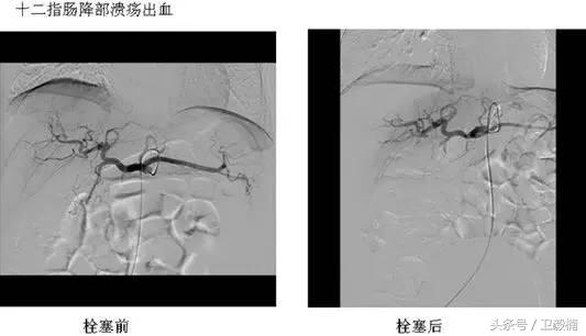 微创介入科一卫毅楠,什么是血汗管介入治疗