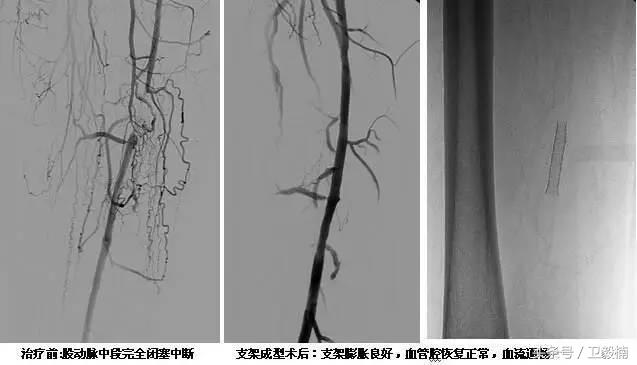 微创介入科一卫毅楠,什么是血汗管介入治疗