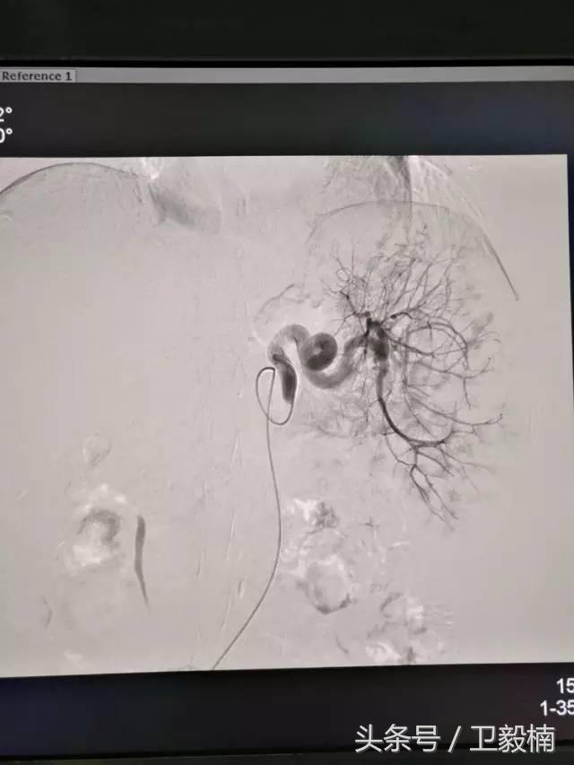 微创介入科一卫毅楠,什么是血汗管介入治疗