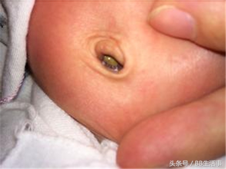 宝宝出生后“肚脐”未长好,护理不当很容易发炎!