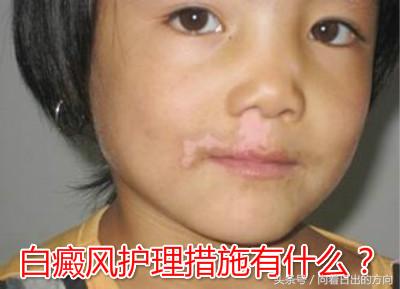 白癜风反反复复，难道真的治不好吗？
