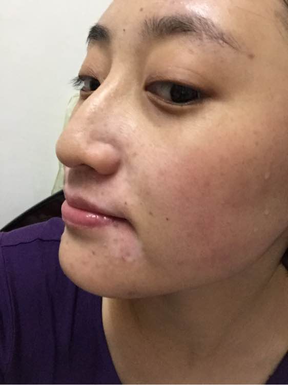 白斑光照,白斑光照后图片