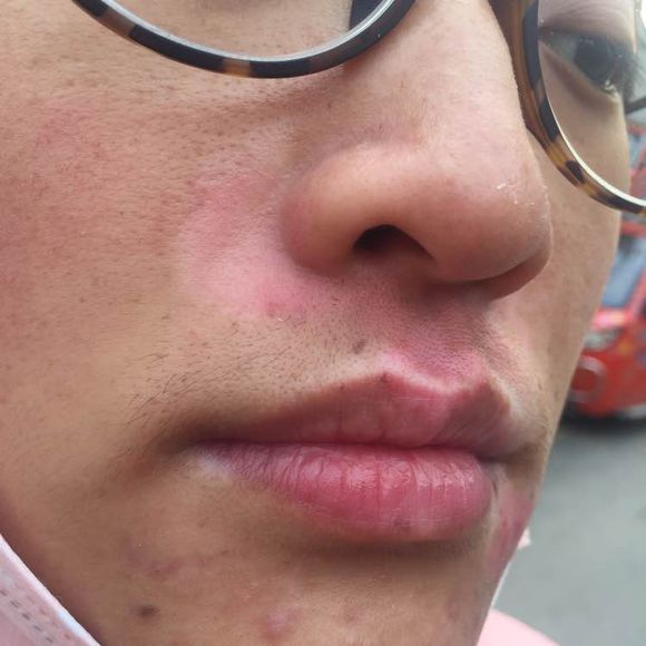 白斑光照,白斑光照后图片