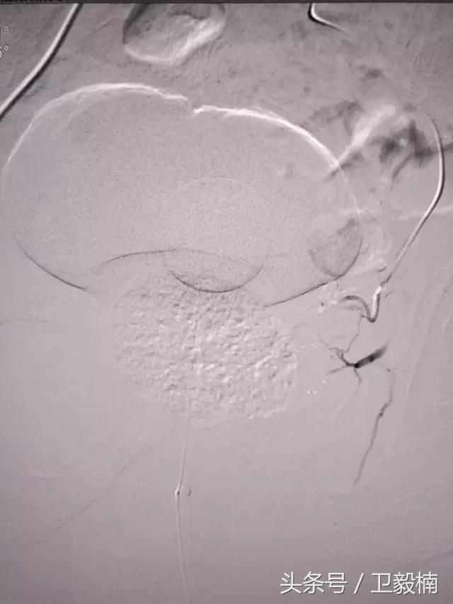 微创介入科一卫毅楠,什么是血汗管介入治疗