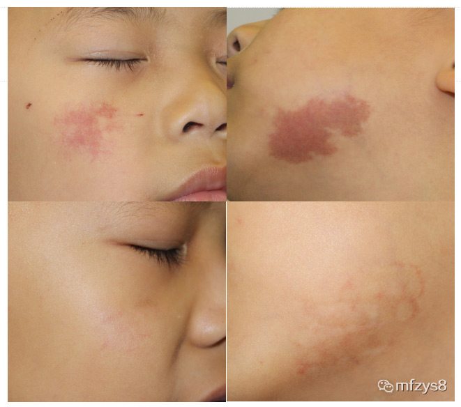 有没有治疗胎记特效药一天治好,胎记是夏天治疗好还是冬天治疗好