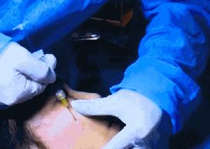 怀孕不谨慎打了瘦脸针会有影响吗,有没有孕妇打瘦脸针的