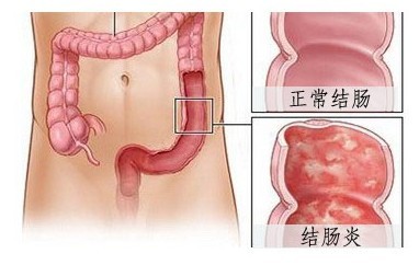 经常拉肚子，便黏液脓血，要关注，谨慎得这个病