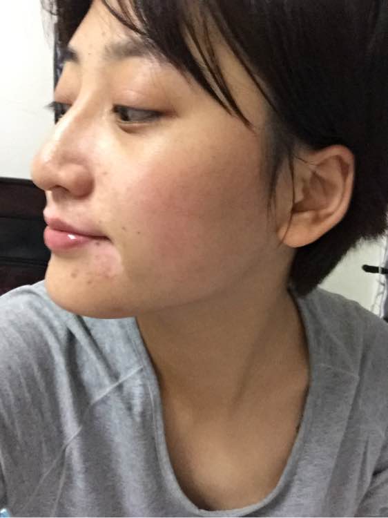 白斑光照,白斑光照后图片