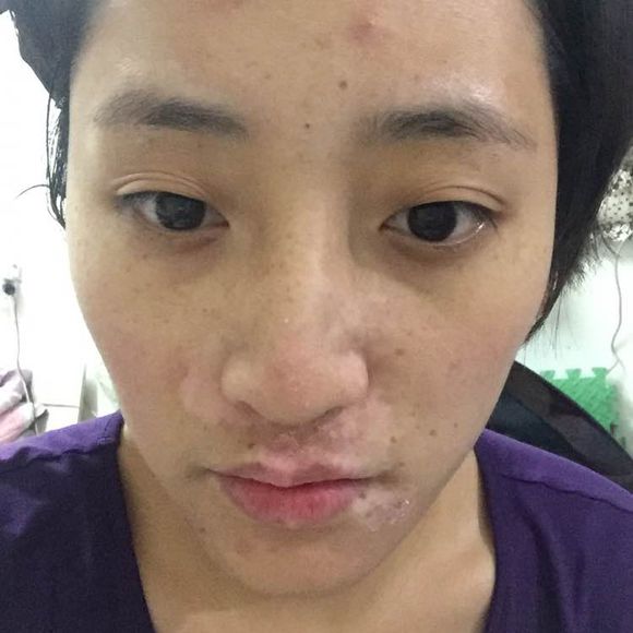 白斑光照,白斑光照后图片