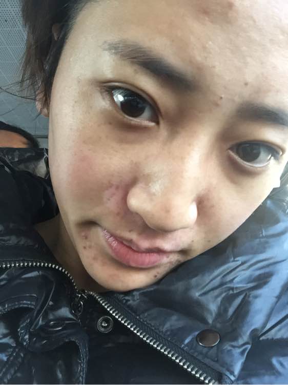 白斑光照,白斑光照后图片