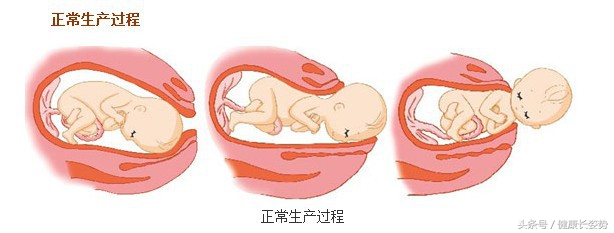 胎位不正能不能顺产呢,胎位不正能不能入盆