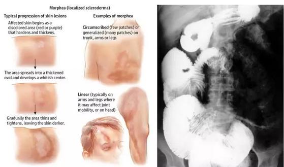结缔组织病前兆,结缔组织病50岁死亡率高吗
