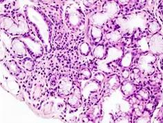 结缔组织病前兆,结缔组织病50岁死亡率高吗