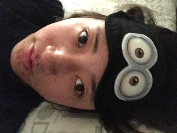 白斑光照,白斑光照后图片