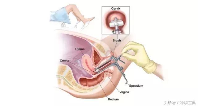 妇科检查前需要关注的事项,妇科支原体检查前要关注什么