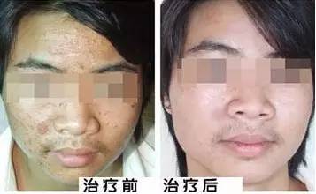 手上扁平疣,祛除扁平疣