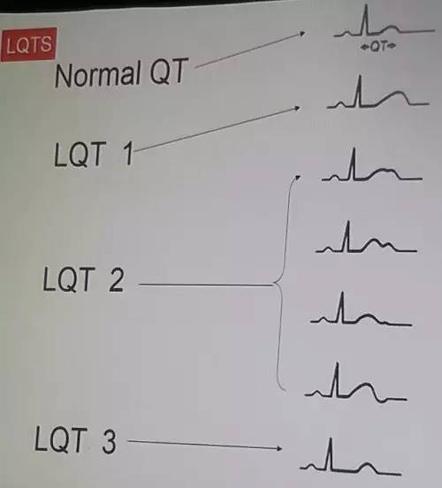 遗传性心律失常怎样治,先天性心律失常的治疗及常用药