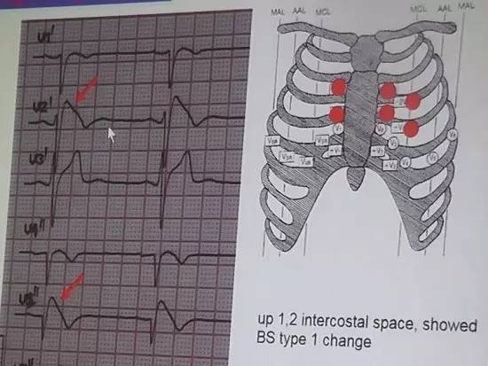 遗传性心律失常怎样治,先天性心律失常的治疗及常用药