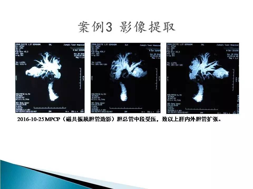 中国科学院肿瘤医院顶级肝癌专家,清华长庚医院肝癌介入治疗