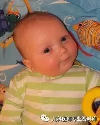 痉挛性斜颈患者说出了大秘密,痉挛性斜颈脖子歪照片