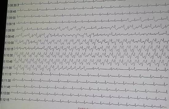 遗传性心律失常怎样治,先天性心律失常的治疗及常用药