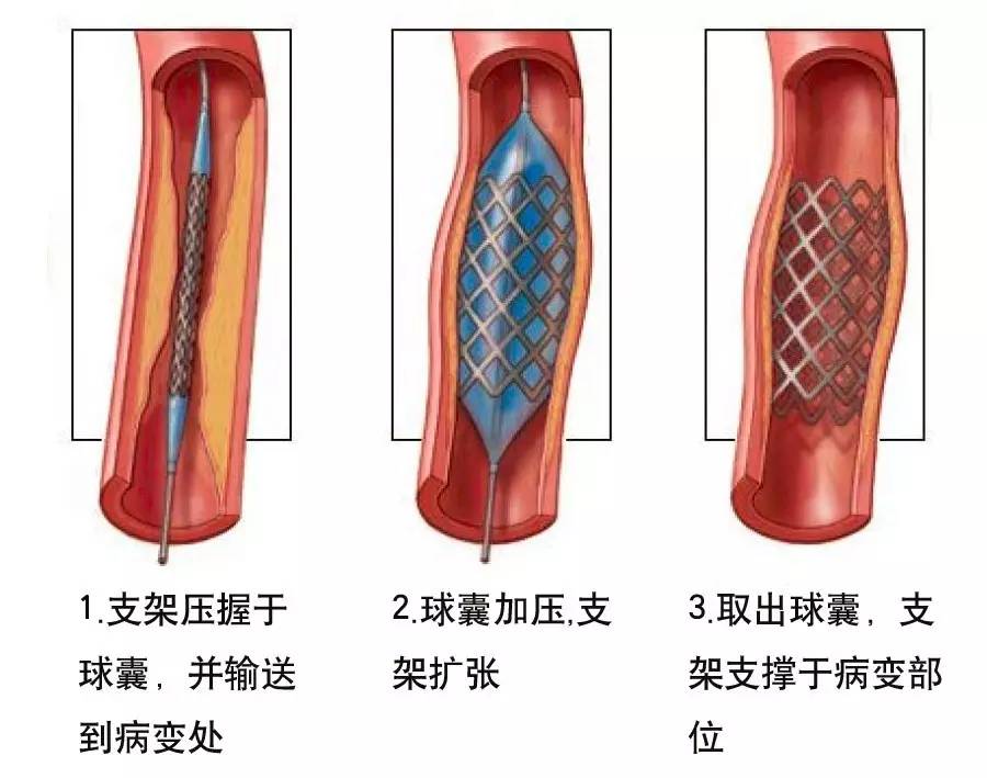 中国科学院肿瘤医院顶级肝癌专家,清华长庚医院肝癌介入治疗