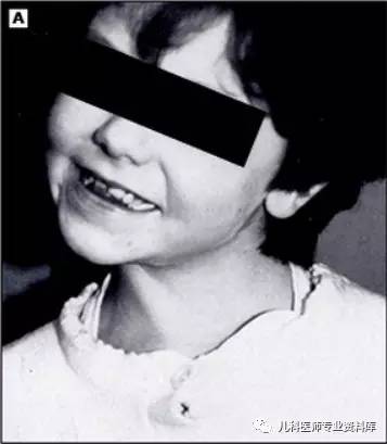 痉挛性斜颈患者说出了大秘密,痉挛性斜颈脖子歪照片