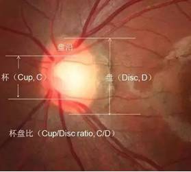 青光眼杯盘比用什么方法测量,先天性杯盘大会得青光眼吗