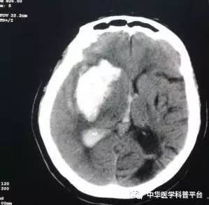 牙龈自发出血是什么病的前兆,自发出血是什么意思