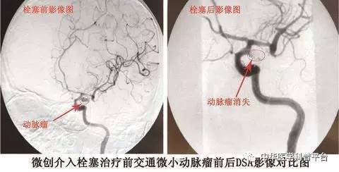 牙龈自发出血是什么病的前兆,自发出血是什么意思