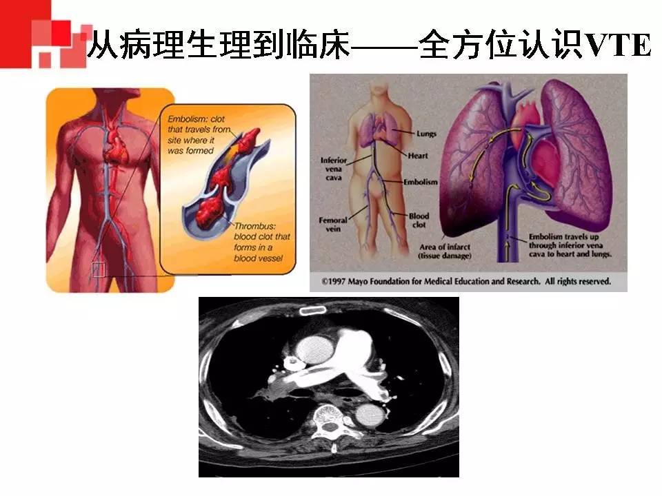 解读︱静脉血栓栓塞症预防和治疗指南