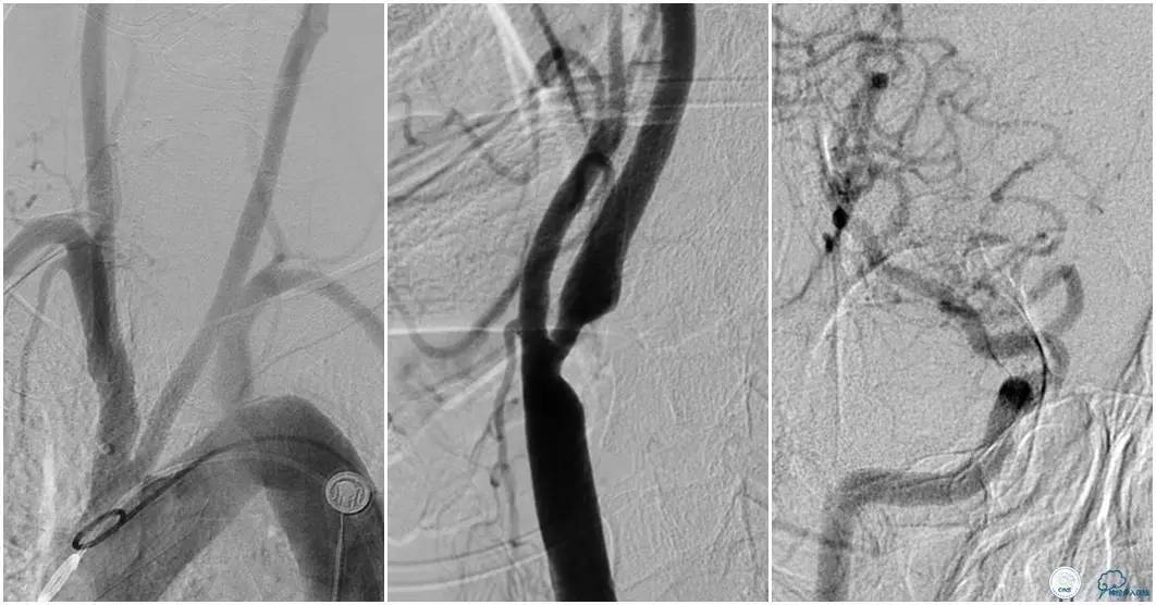 CINS2016病例展｜一例双侧大脑前动脉栓塞的再通治疗
