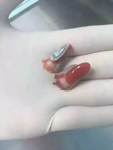 老师给幼儿剪指甲不谨慎剪到手,幼儿园小孩被老师剪指甲流血