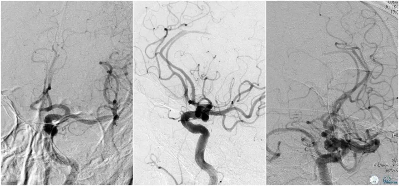 CINS2016病例展｜一例双侧大脑前动脉栓塞的再通治疗