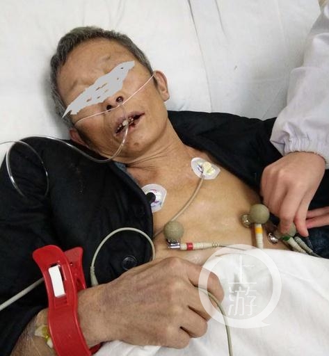 湖南一老人拘押期间身亡，曾在看守所内断了14根肋骨