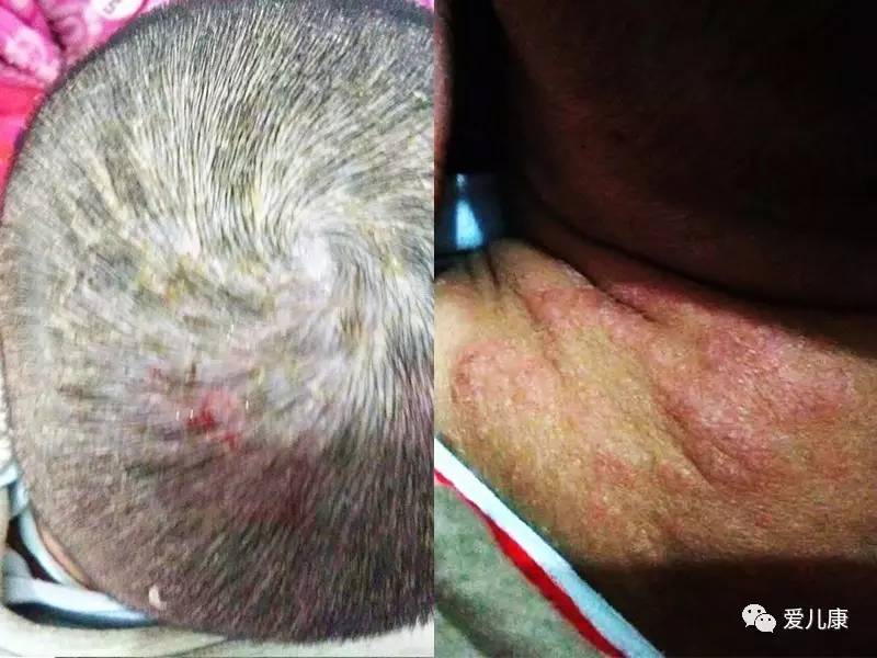 宝宝脂溢性皮炎怎么治疗效果最好,脂溢性皮炎宝宝要关注哪些方面