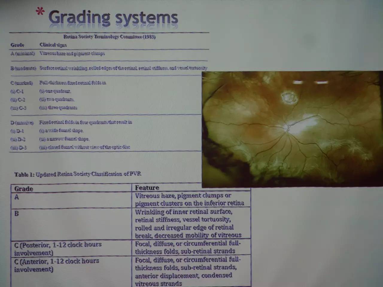 pvr眼科上是什么意思,pvr在眼底是什么病