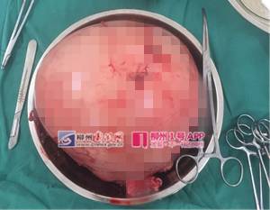 「惊呆」柳州一大妈肚子大得像怀孕7个月，医生打开后惊呆了……