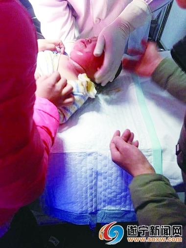 女孩被烧伤网友捐款救人,小女孩烧伤毁容被医学援助