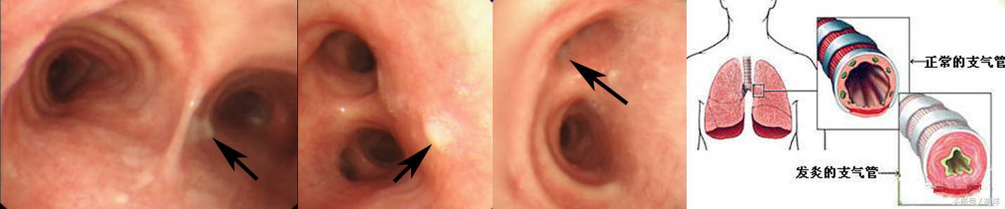 咳嗽气管炎3天自愈最佳疗法,气管炎咳嗽一个星期还是不好