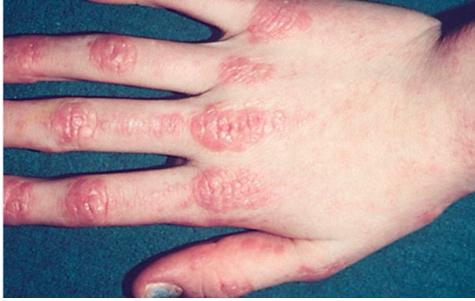 皮肌炎和多发性肌炎是什么样的疾病？