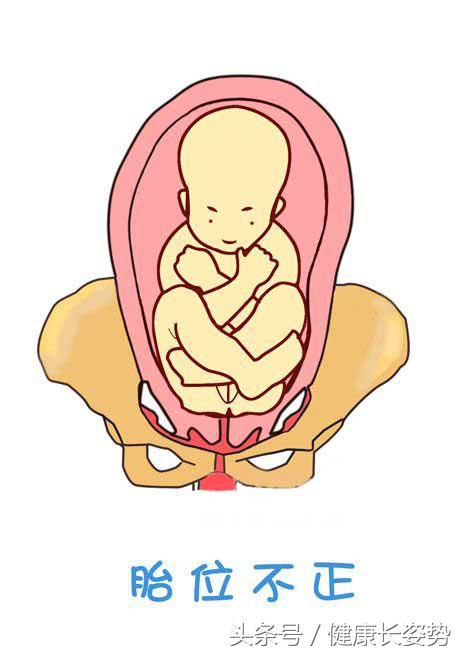 胎位不正能不能顺产呢,胎位不正能不能入盆