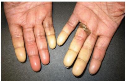 皮肌炎和多发性肌炎是什么样的疾病？