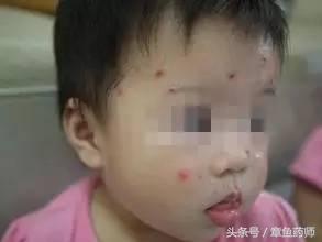 关注水痘高发期这些知识需知,谨慎传染病高发期