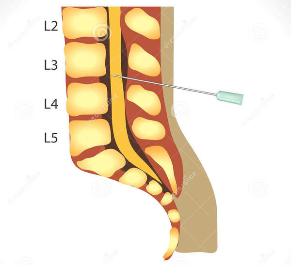 腰椎穿刺术操作流程完成时间,腰椎穿刺术操作考核评分标准