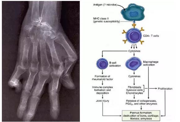 结缔组织病前兆,结缔组织病50岁死亡率高吗