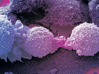 骨髓瘤研究进展,骨髓瘤细胞在骨髓外无限增殖