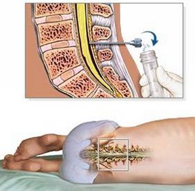 腰椎穿刺术操作流程完成时间,腰椎穿刺术操作考核评分标准